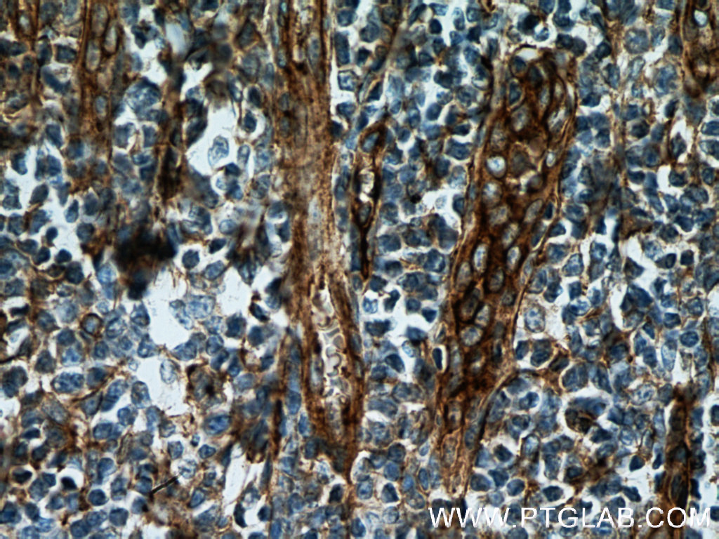 IHC staining of human tonsillitis using 66567-1-Ig