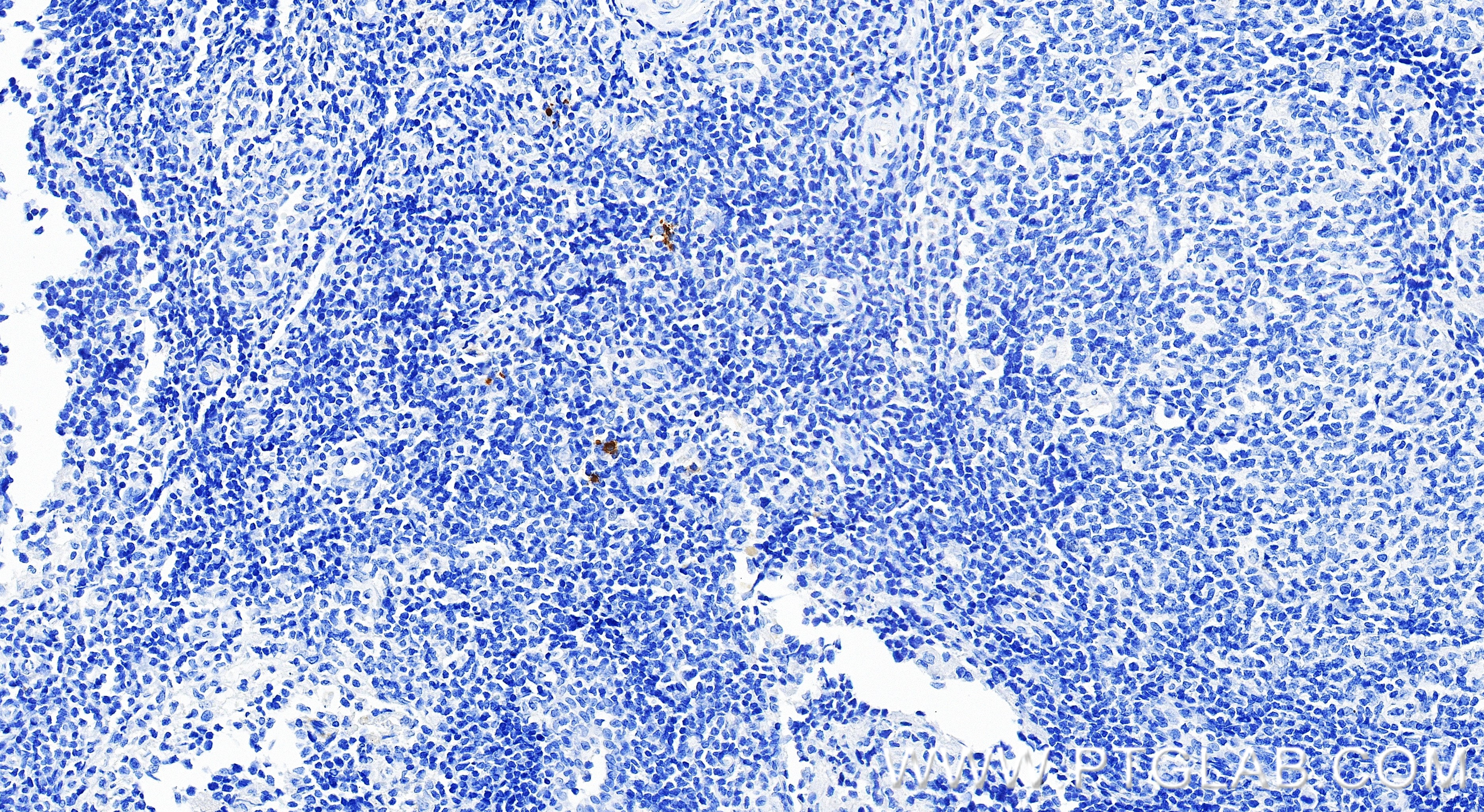 IHC staining of human tonsillitis using 98628-1-RR