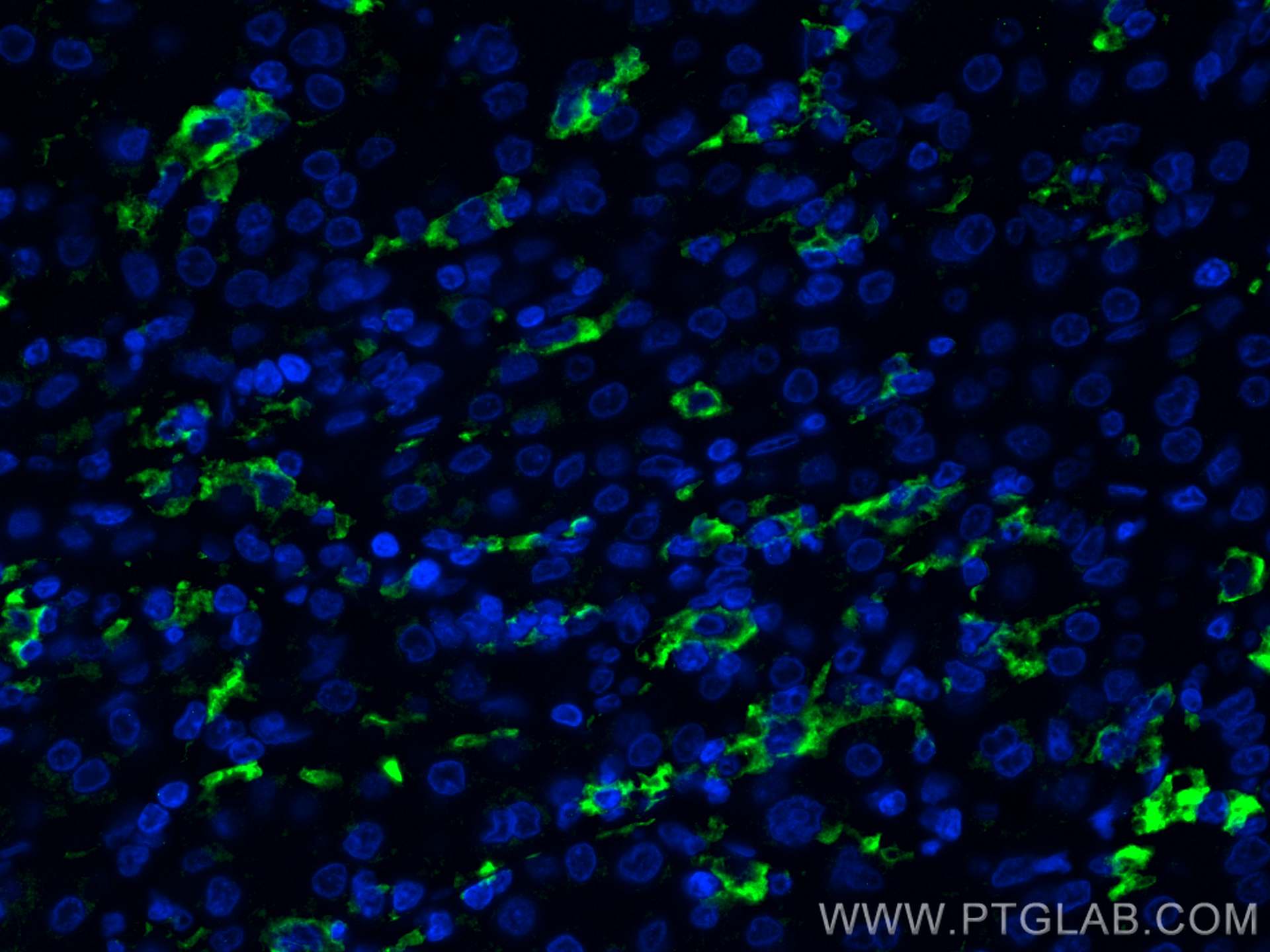 IF Staining of human liver cancer using 16559-1-AP