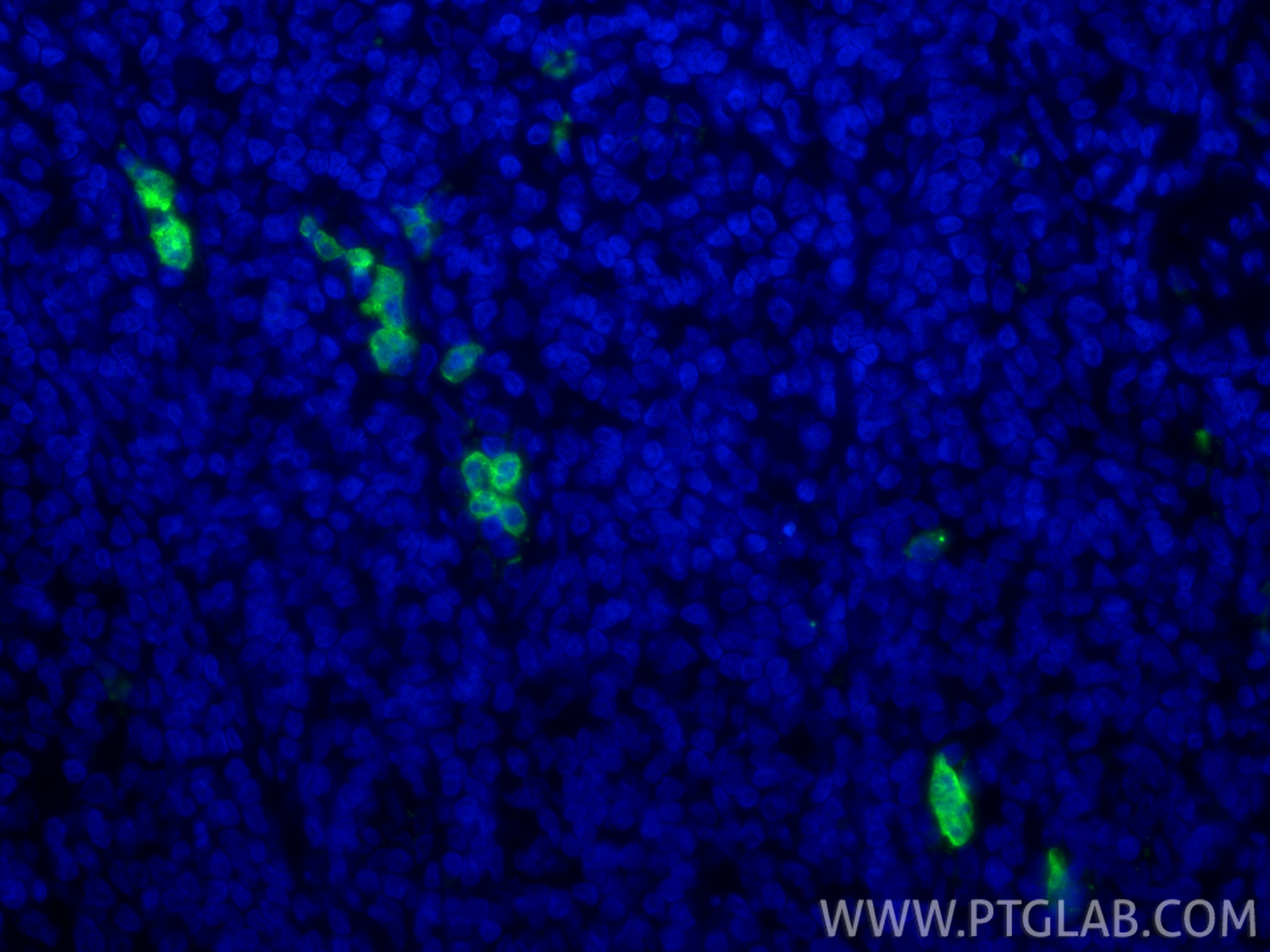 IF Staining of human tonsillitis using 30567-1-AP IF Staining of human tonsillitis using 30567-1-AP