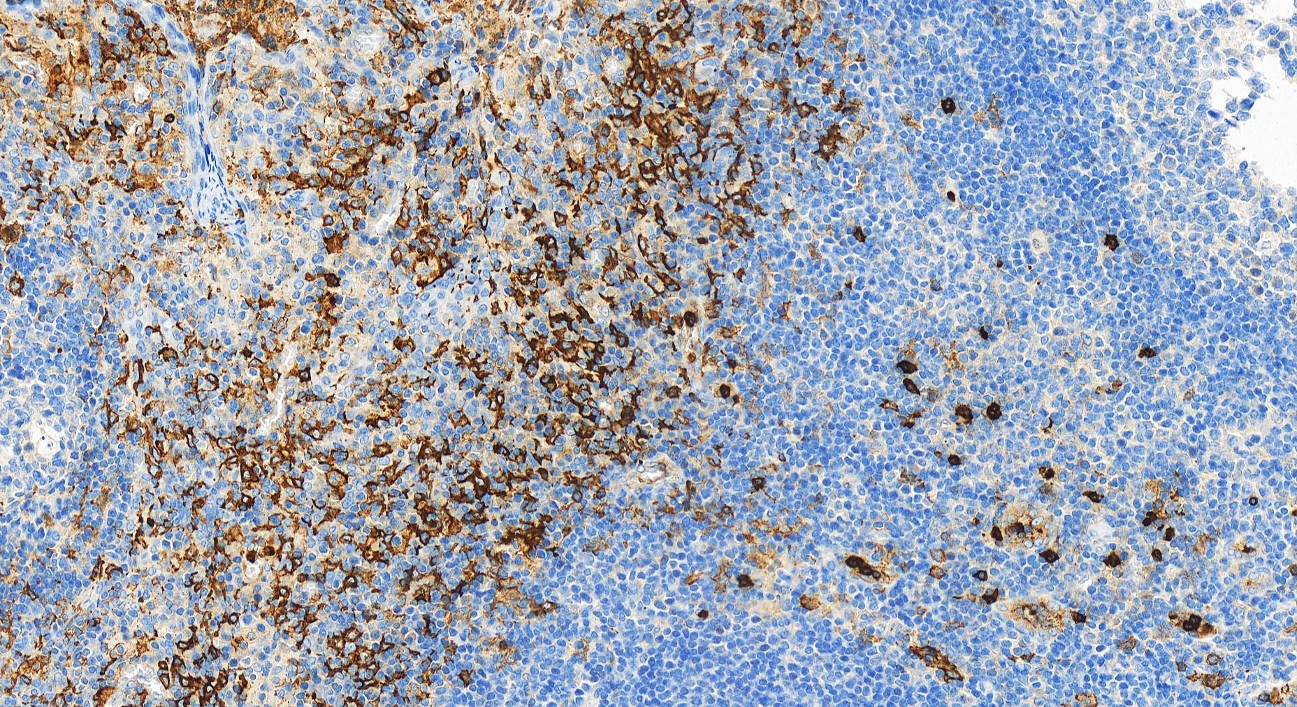 IHC staining of human tonsillitis using 30567-1-AP IHC staining of human tonsillitis using 30567-1-AP