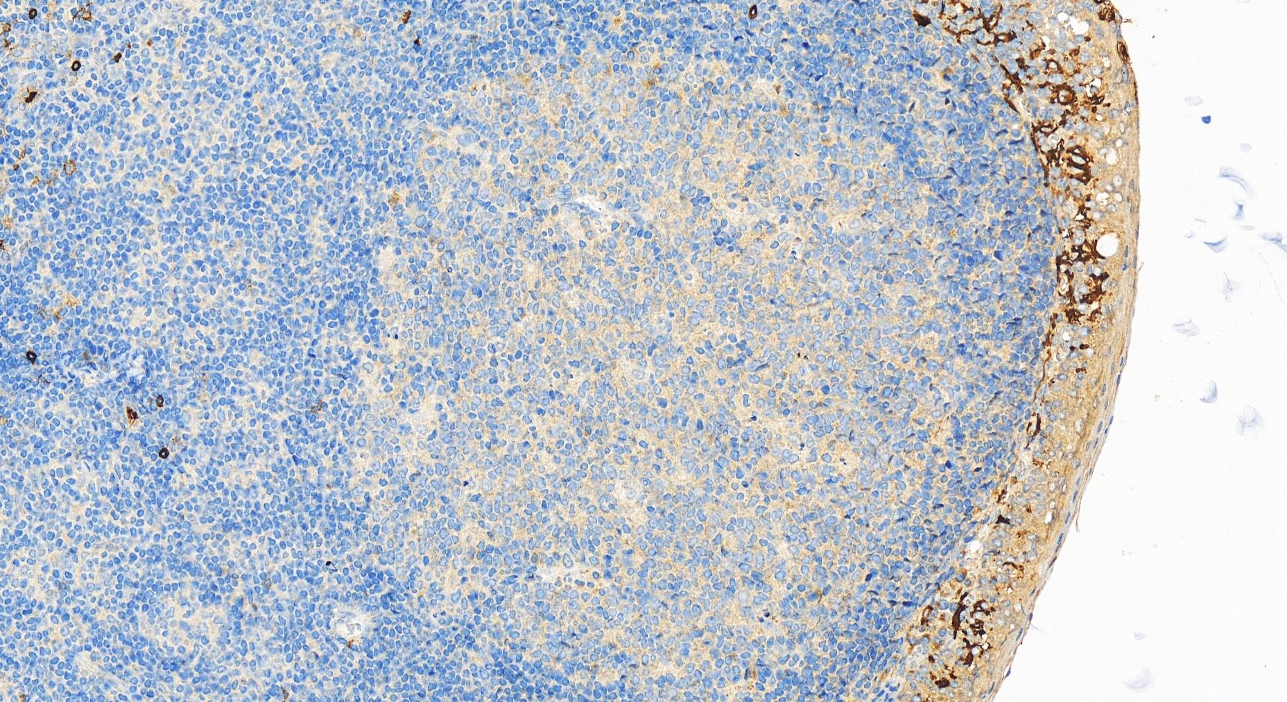 IHC staining of human tonsillitis using 30567-1-AP IHC staining of human tonsillitis using 30567-1-AP