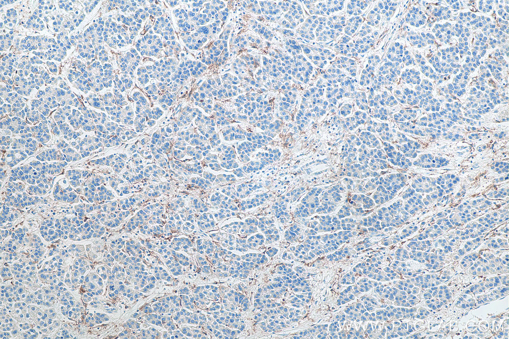 IHC staining of human liver cancer using 66779-1-Ig