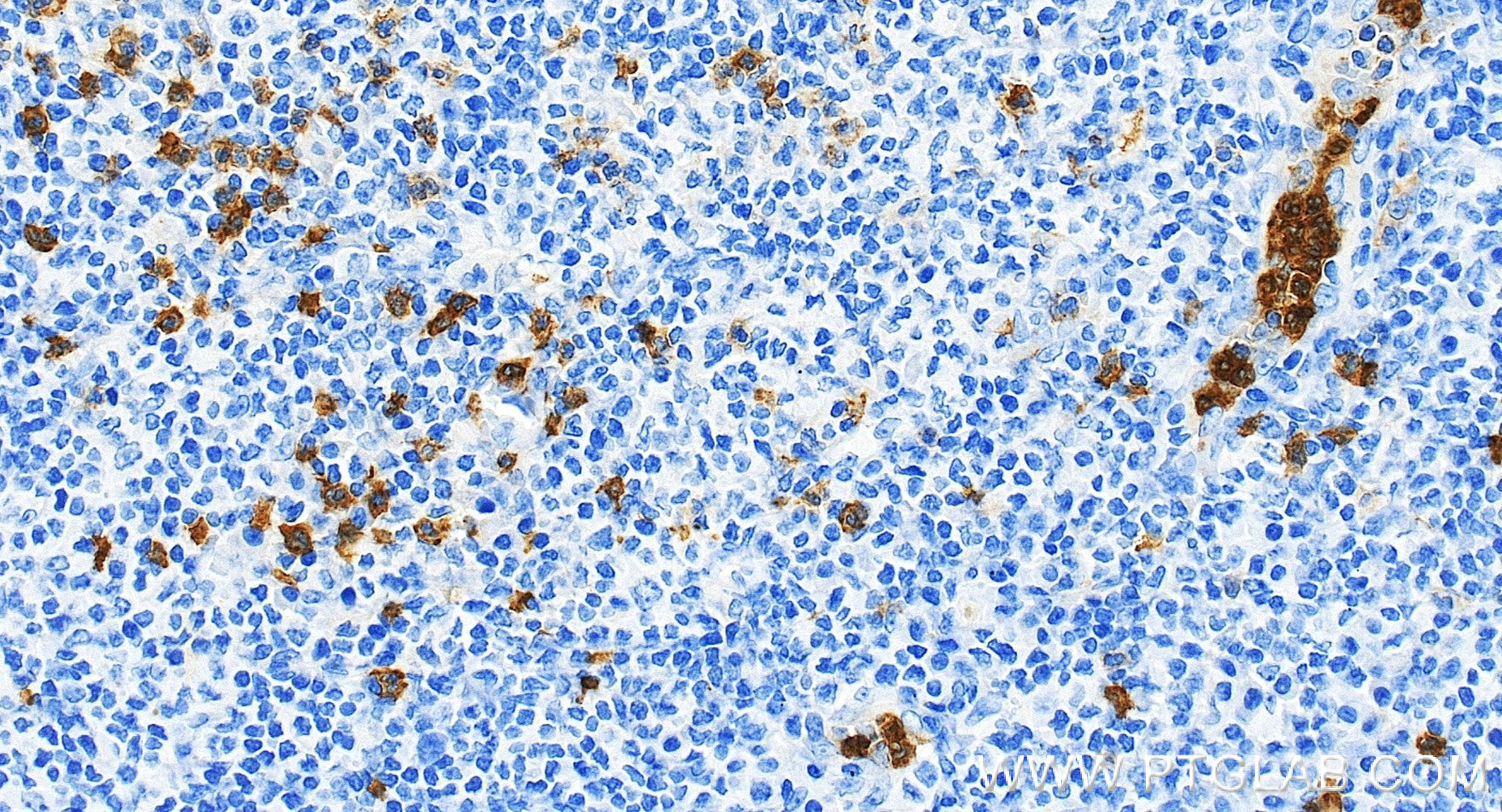 IHC staining of human tonsillitis using 83110-2-RR (same clone as 83110-2-PBS) IHC staining of human tonsillitis using 83110-2-RR (same clone as 83110-2-PBS)
