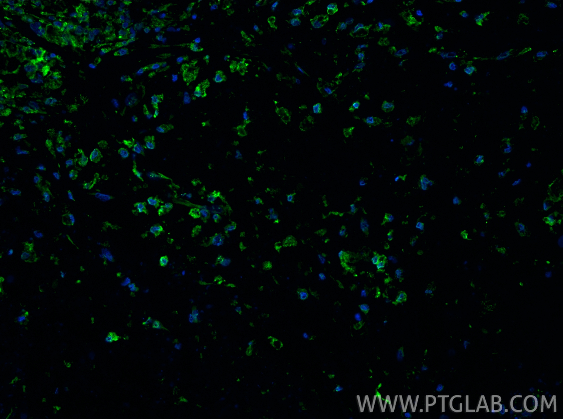 IF Staining of human lung cancer using 16646-1-AP IF Staining of human lung cancer using 16646-1-AP