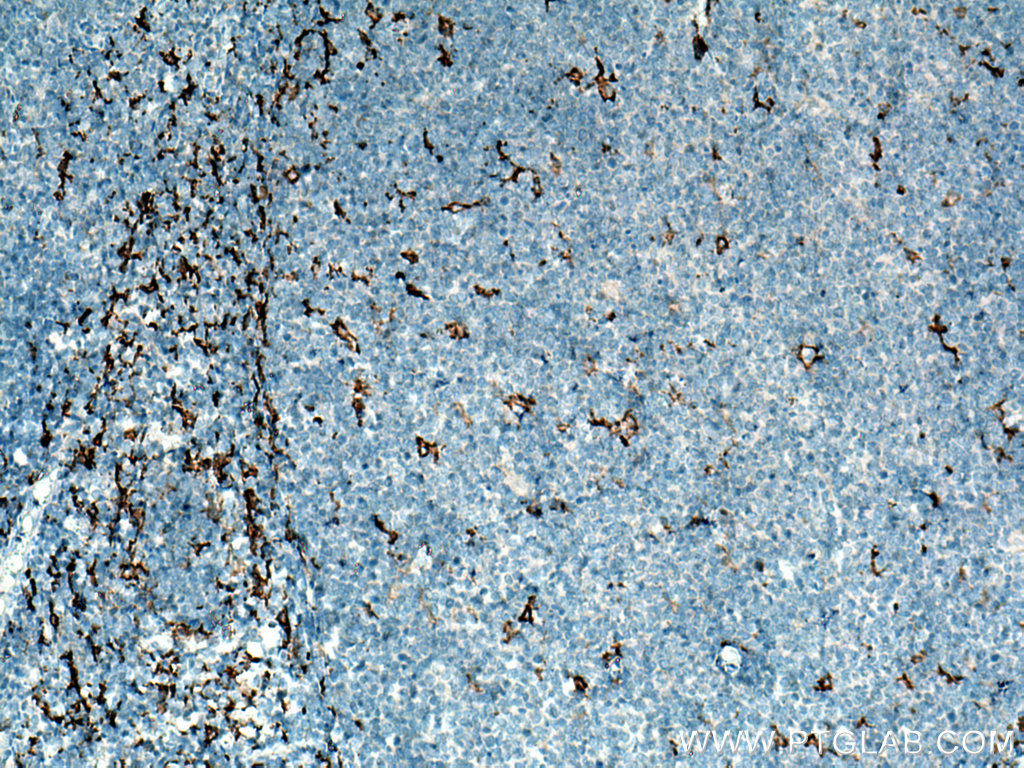 IHC staining of human tonsillitis using 16646-1-AP