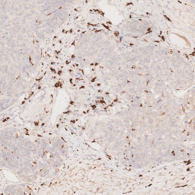IHC staining of human ovary cancer using 68218-1-Ig IHC staining of human ovary cancer using 68218-1-Ig