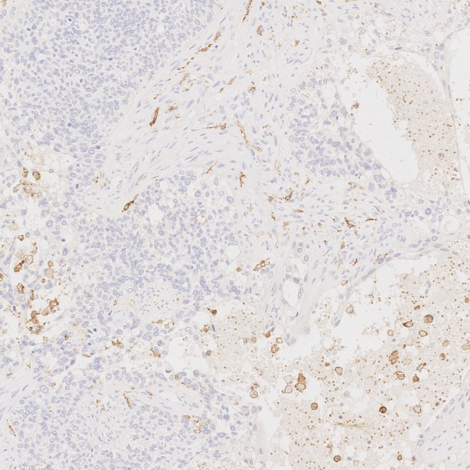 IHC staining of human ovary cancer using 68218-1-Ig IHC staining of human ovary cancer using 68218-1-Ig