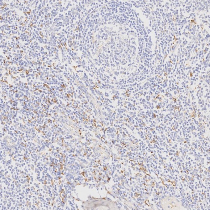 IHC staining of human tonsillitis using 68218-1-Ig IHC staining of human tonsillitis using 68218-1-Ig