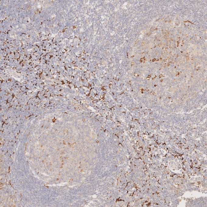 IHC staining of human tonsillitis using 68218-1-Ig IHC staining of human tonsillitis using 68218-1-Ig
