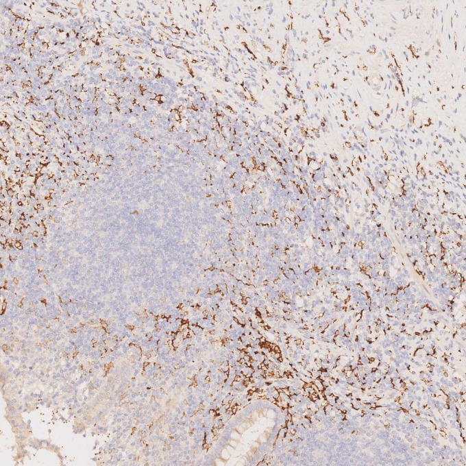 IHC staining of human appendicitis using 68218-1-Ig IHC staining of human appendicitis using 68218-1-Ig