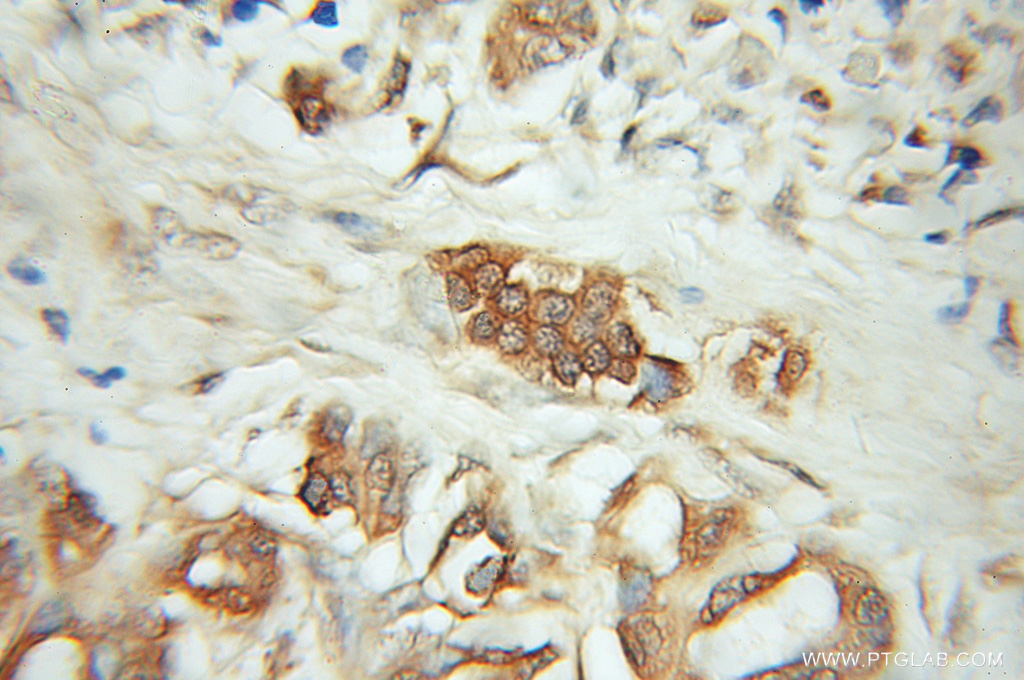 IHC staining of human pancreas cancer using 12083-2-AP