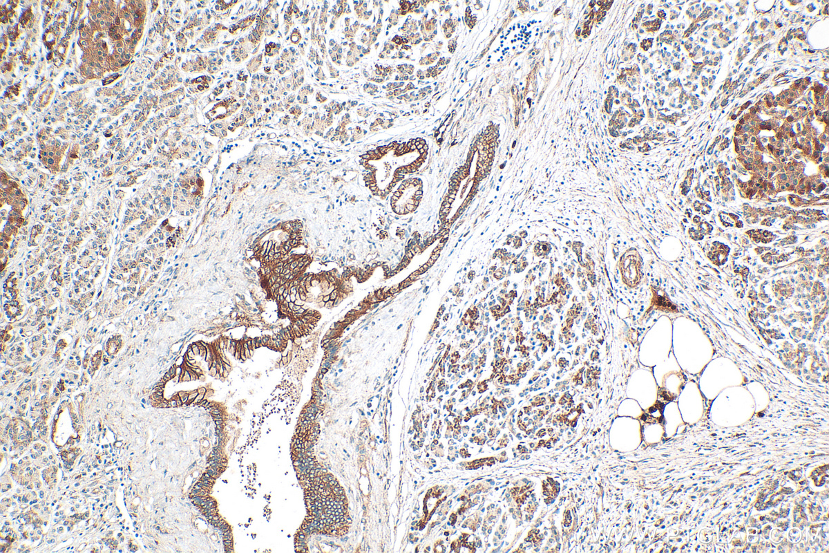 IHC staining of human pancreas cancer using 25488-1-AP