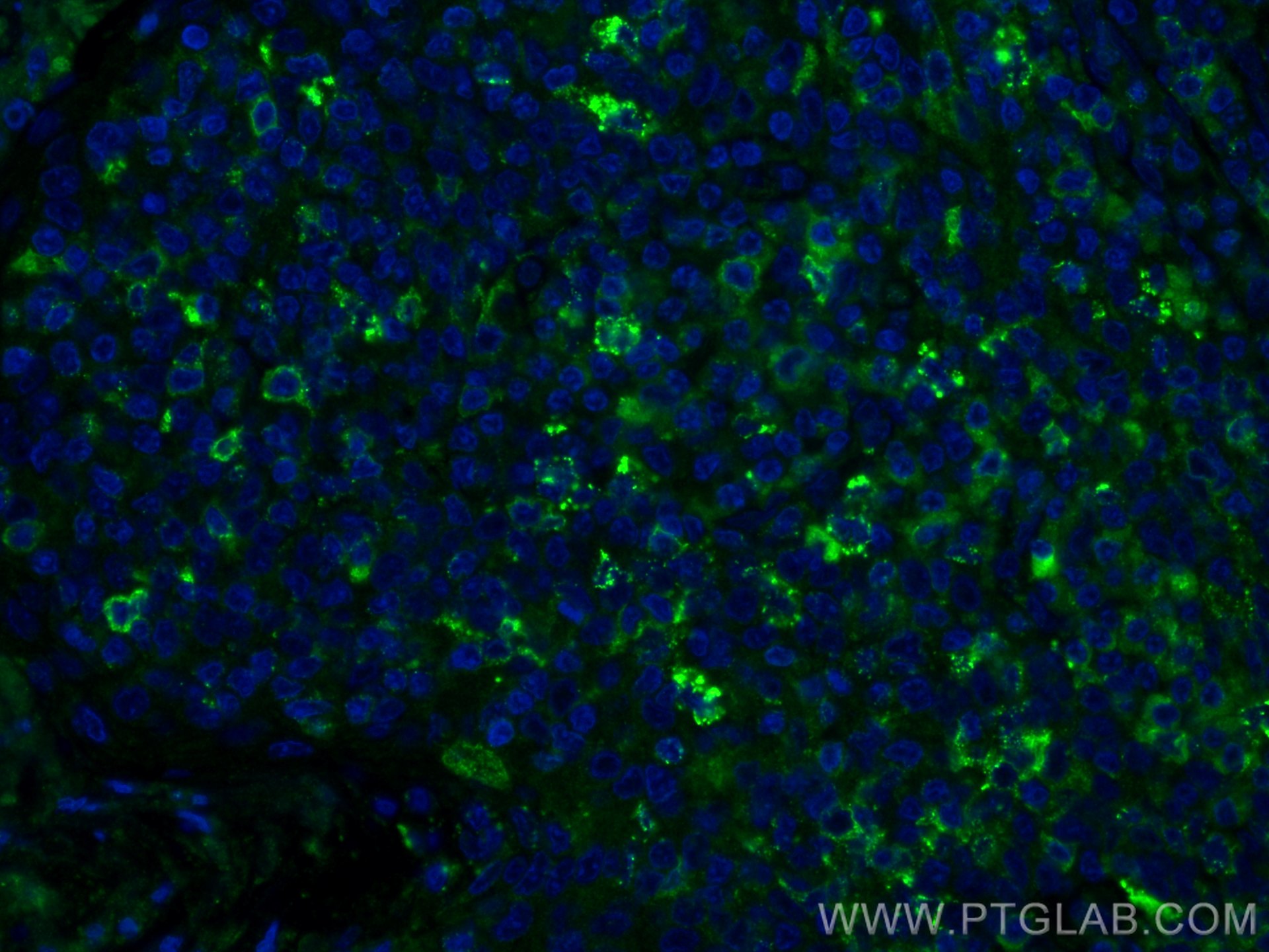 IF Staining of human tonsillitis using 55427-1-AP