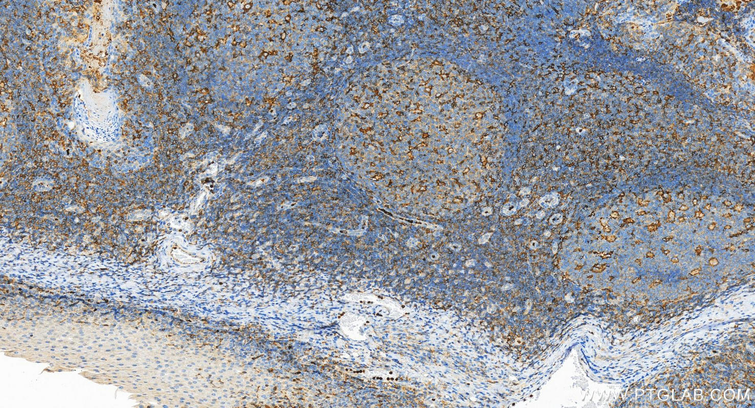 IHC staining of human tonsillitis using 10554-1-AP