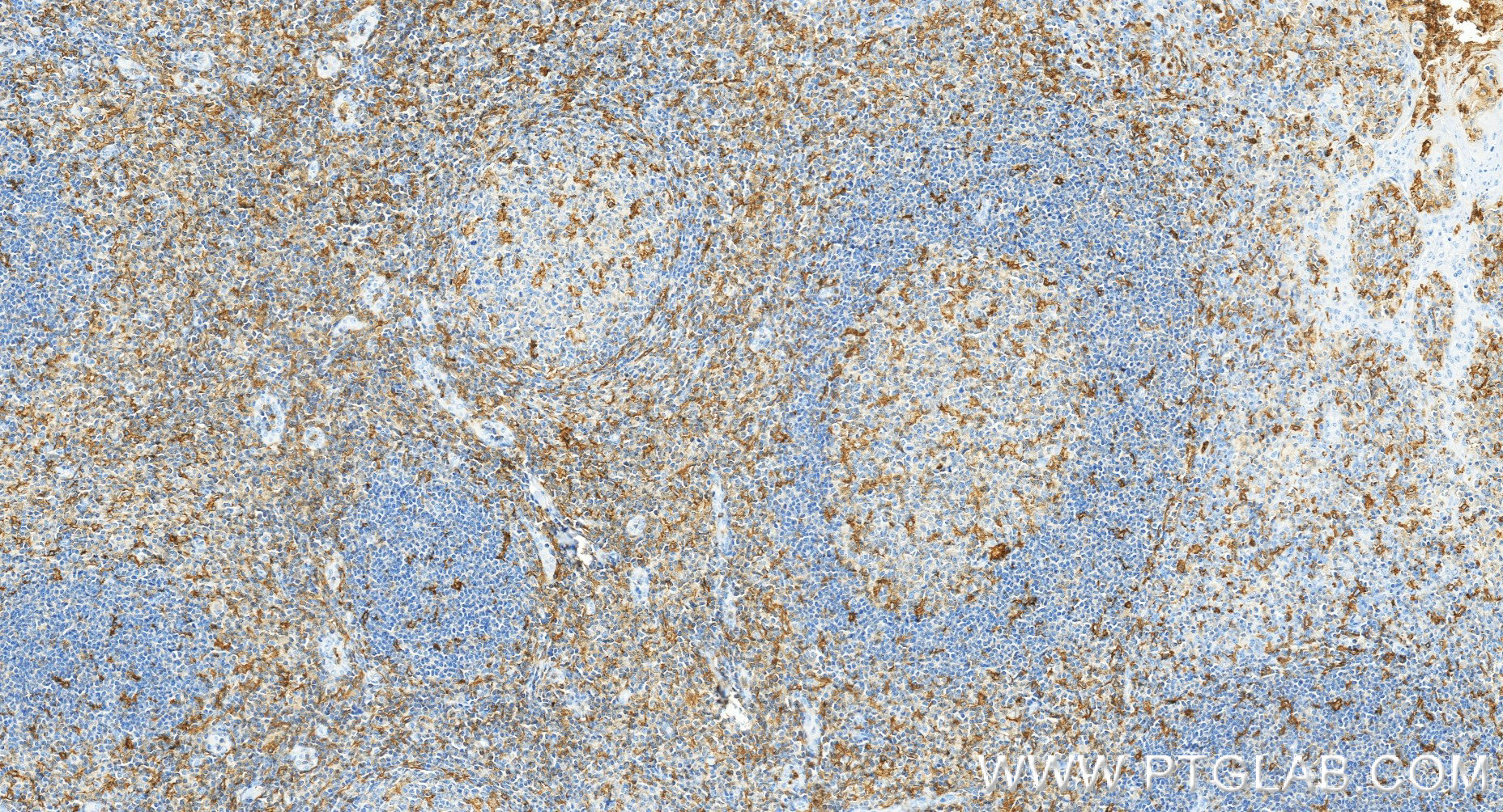 IHC staining of human tonsillitis using 87449-1-RR IHC staining of human tonsillitis using 87449-1-RR