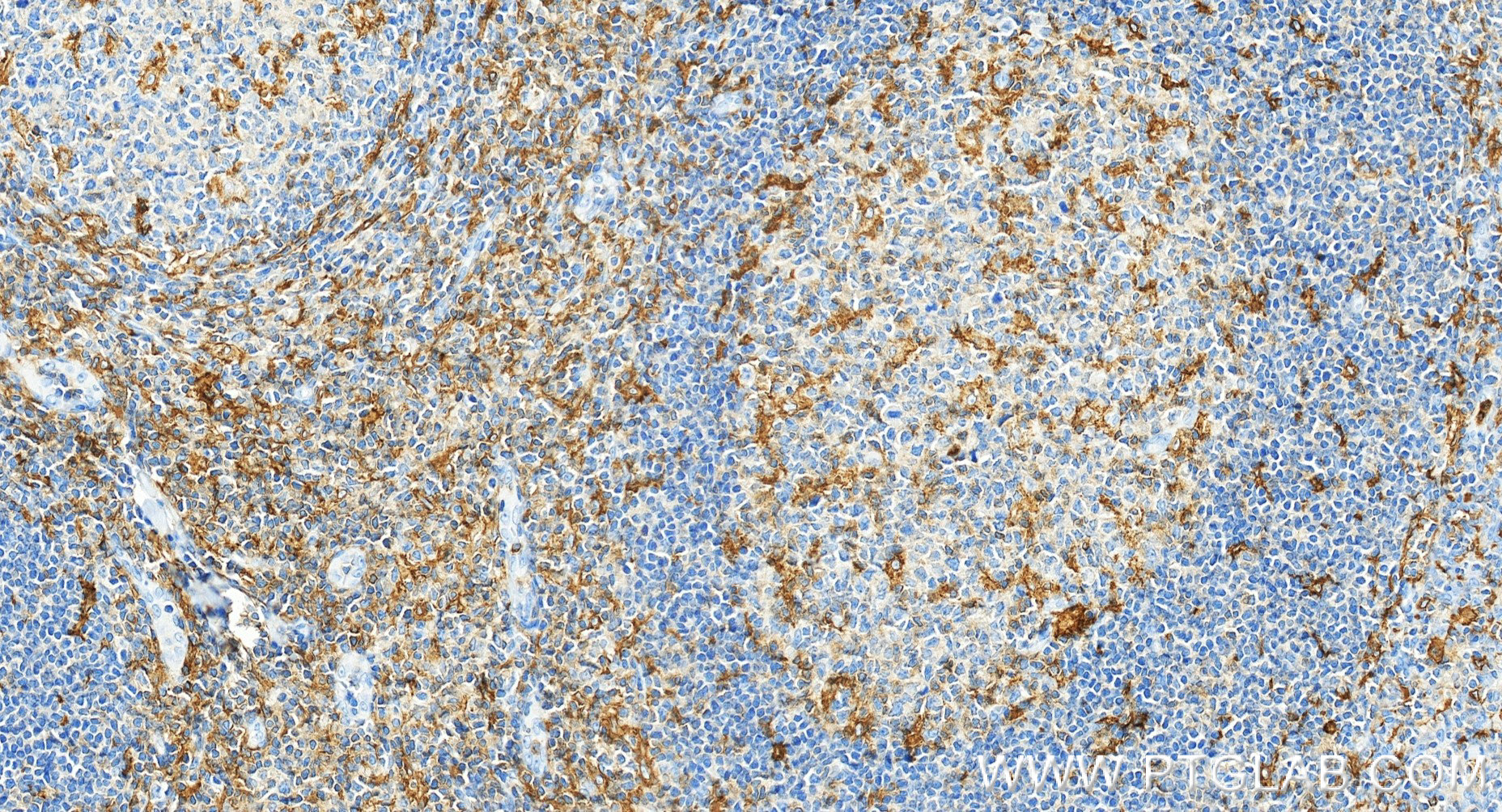 IHC staining of human tonsillitis using 87449-1-RR IHC staining of human tonsillitis using 87449-1-RR