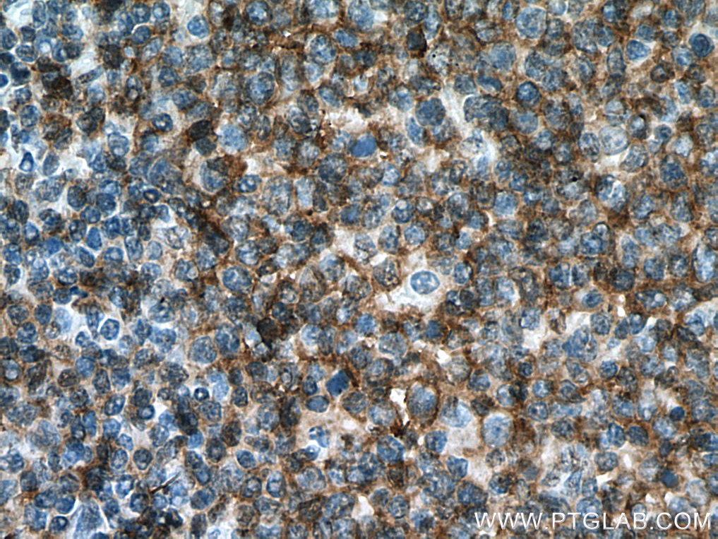 IHC staining of human tonsillitis using 66298-1-Ig