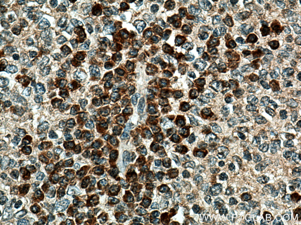 IHC staining of human tonsillitis using 28838-1-AP