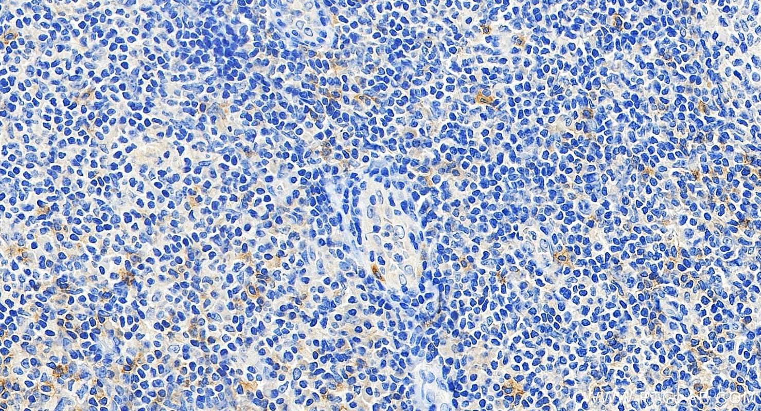 IHC staining of human tonsillitis using 87145-2-RR IHC staining of human tonsillitis using 87145-2-RR