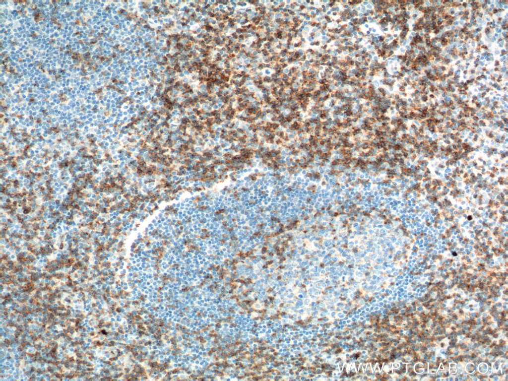 IHC staining of human tonsillitis using 10299-1-AP (same clone as 10299-1-PBS)