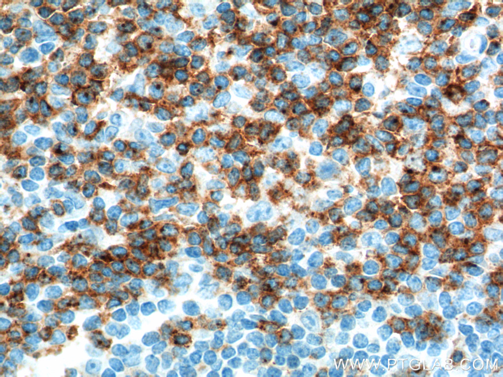 IHC staining of human tonsillitis using 10299-1-AP (same clone as 10299-1-PBS)