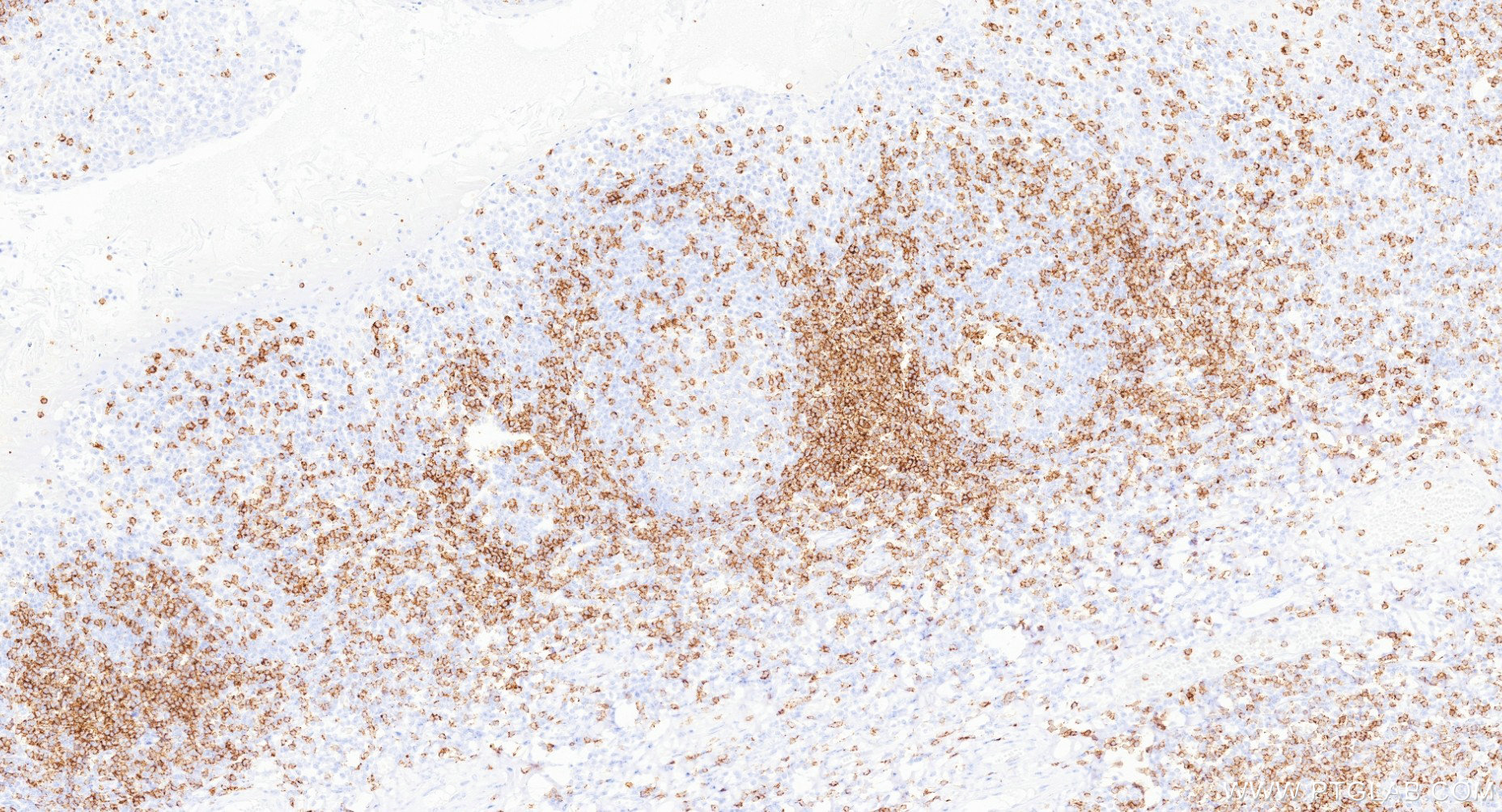 IHC staining of human tonsillitis using 98134-1-RR