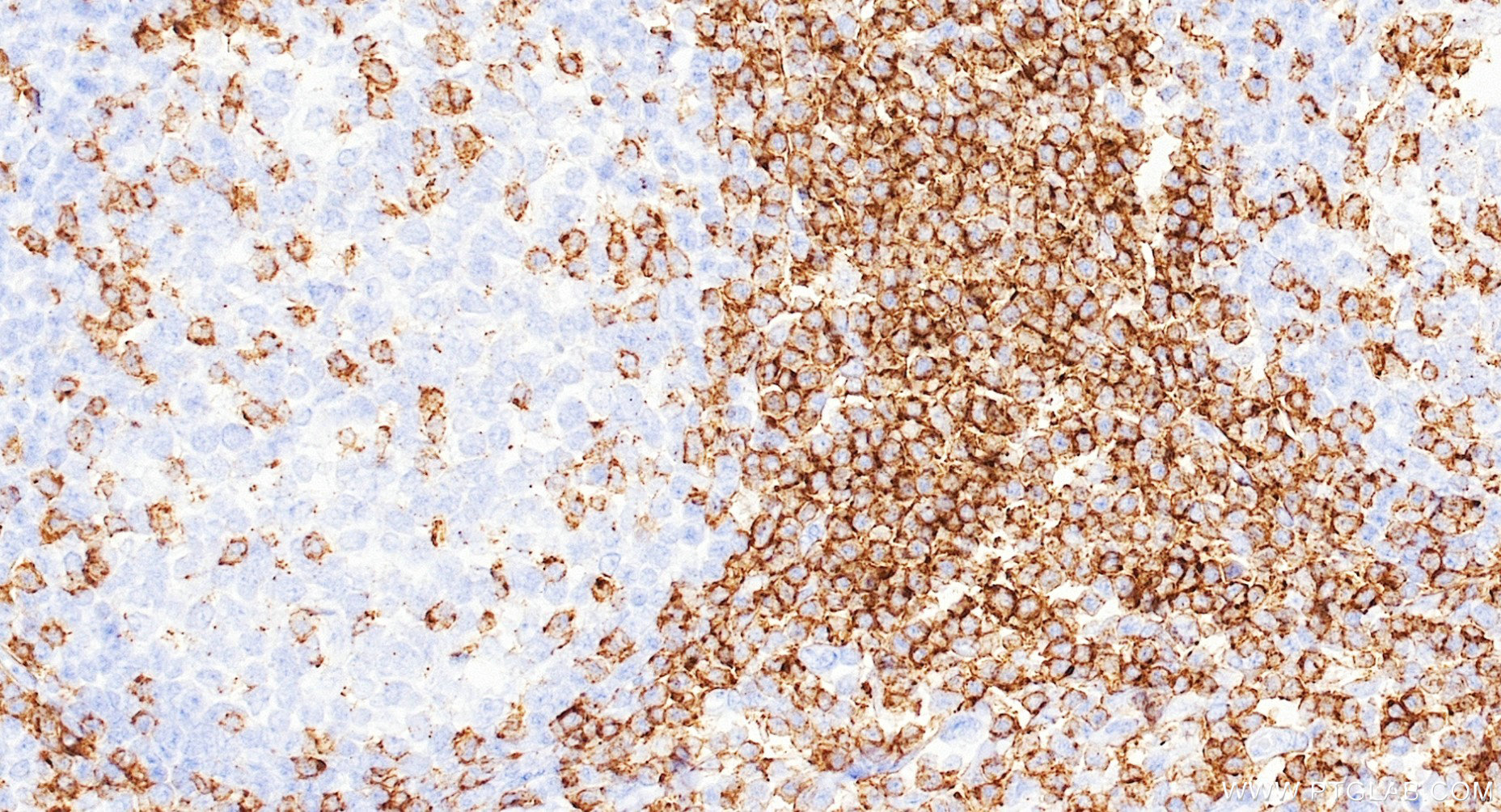 IHC staining of human tonsillitis using 98134-1-RR