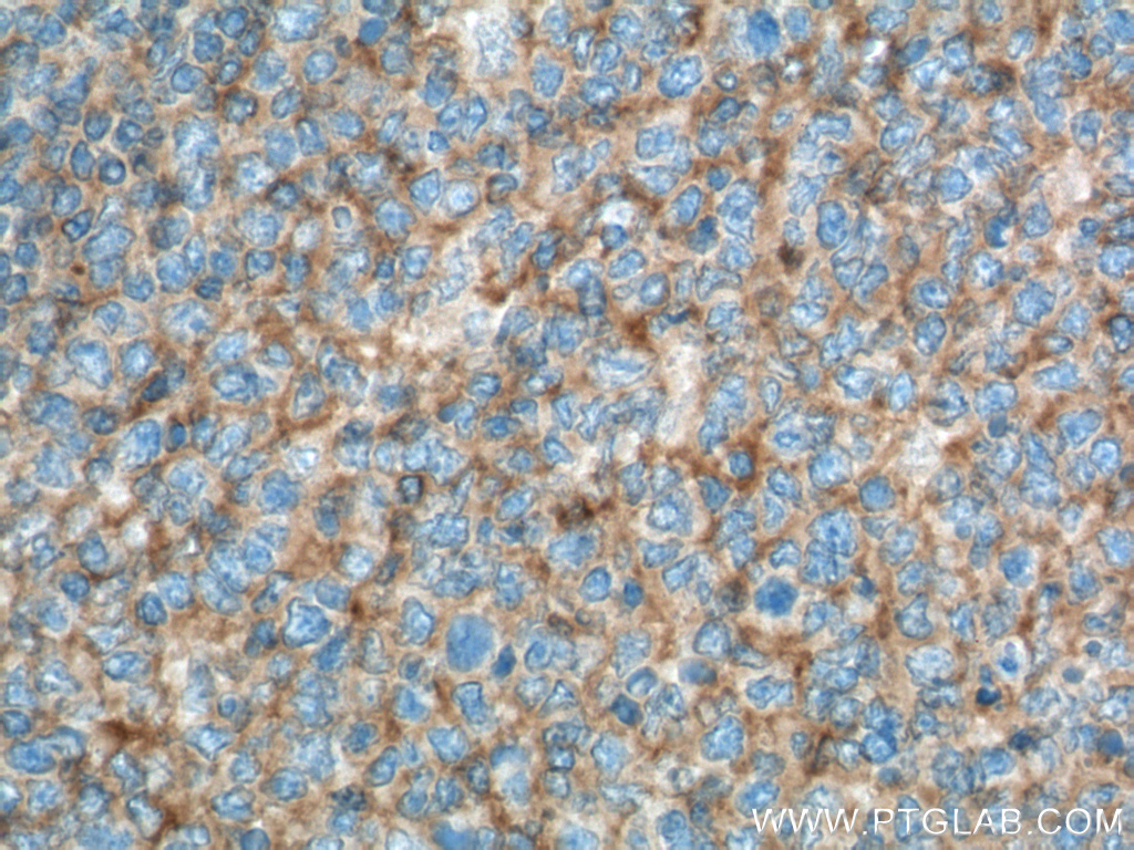 IHC staining of human tonsillitis using 66282-1-Ig