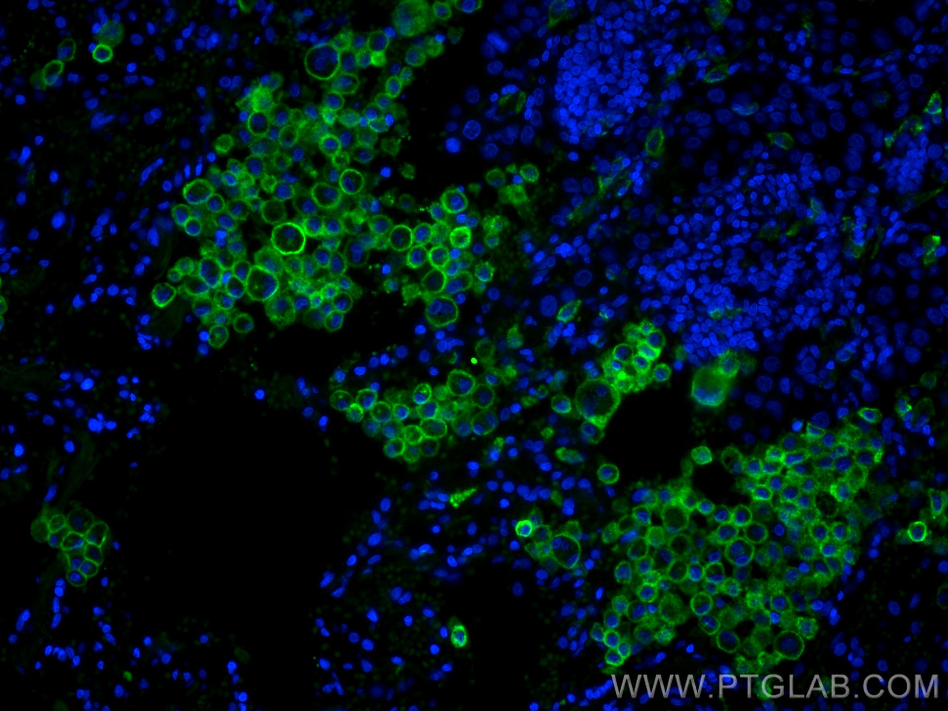 IF Staining of human lung cancer using CL488-60143