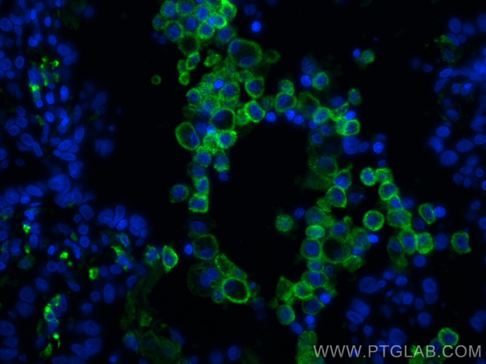 IF Staining of human lung cancer using CL488-60143