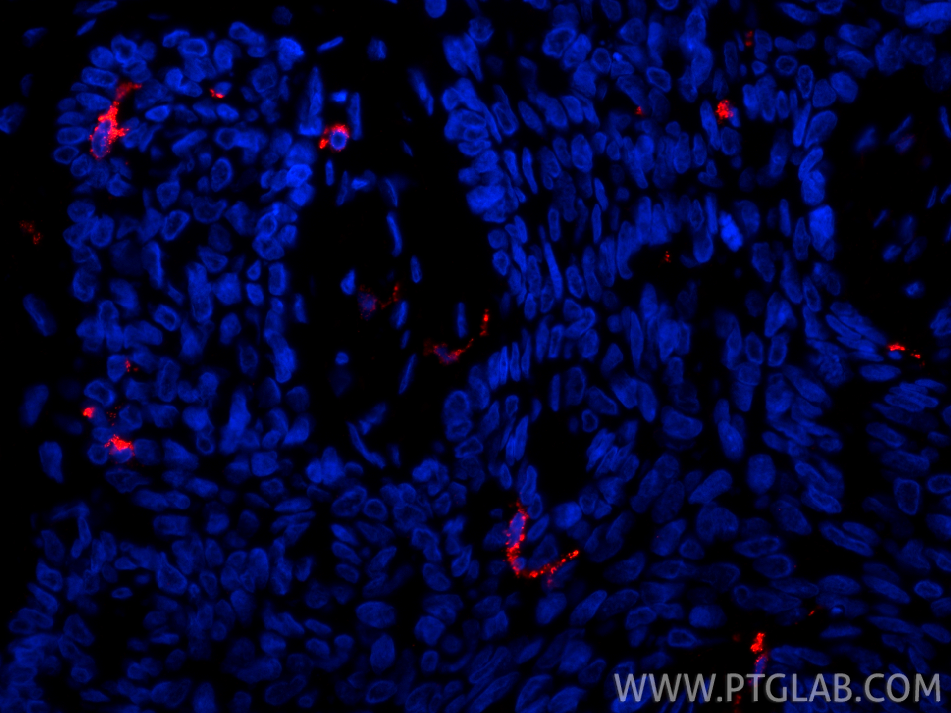 IF Staining of human skin cancer using 67788-1-Ig IF Staining of human skin cancer using 67788-1-Ig