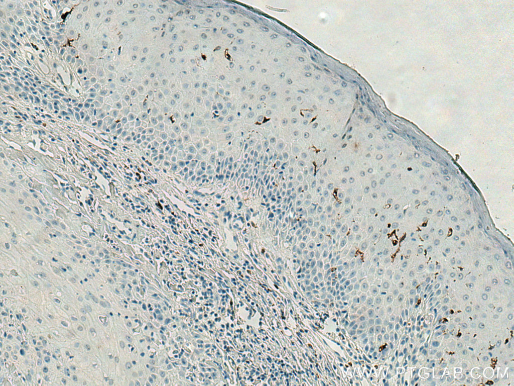 IHC staining of human skin cancer using 67788-1-Ig (same clone as 67788-1-PBS)