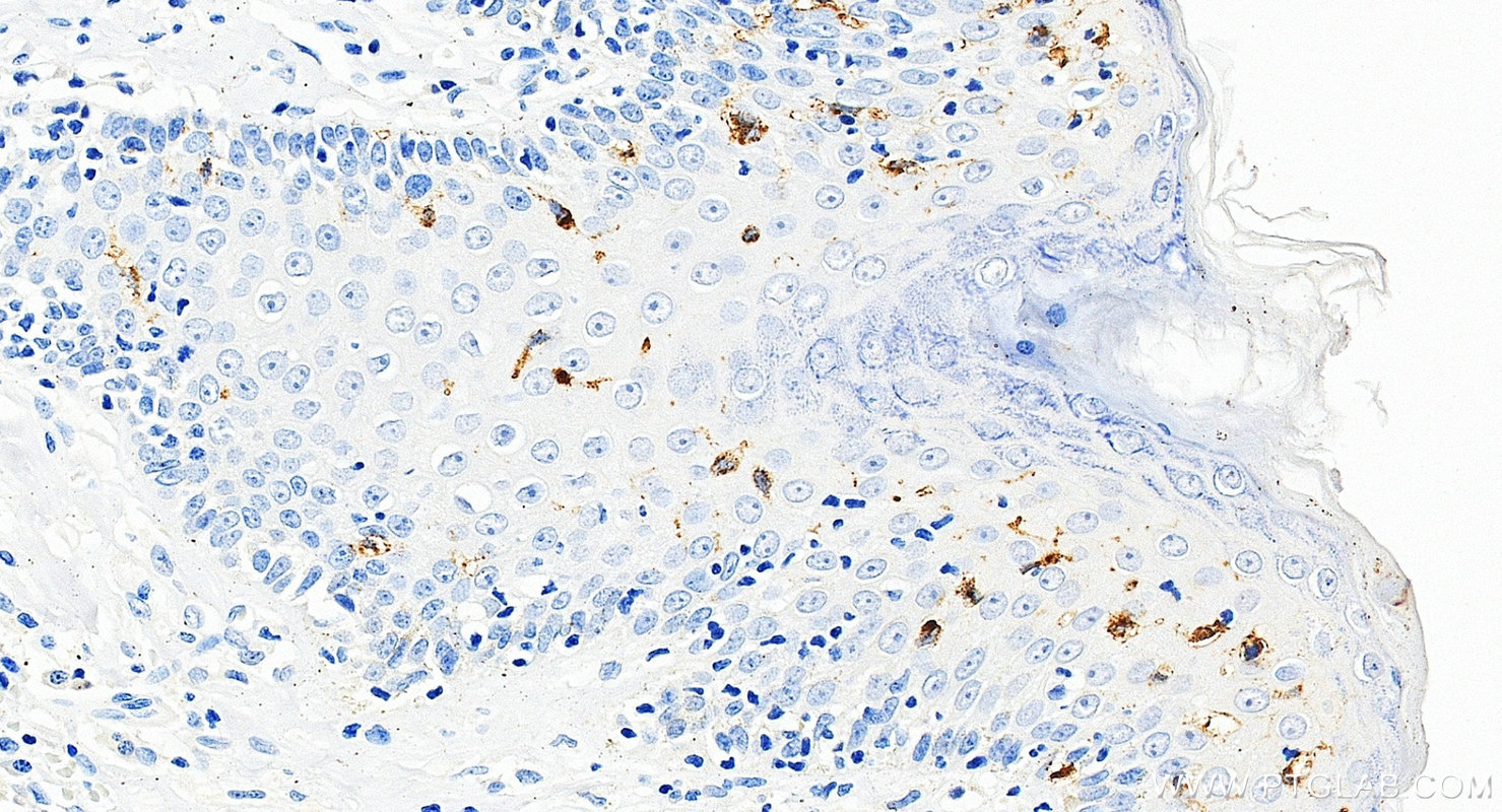 IHC staining of human skin squamous cell cancer using 67788-1-Ig IHC staining of human skin squamous cell cancer using 67788-1-Ig