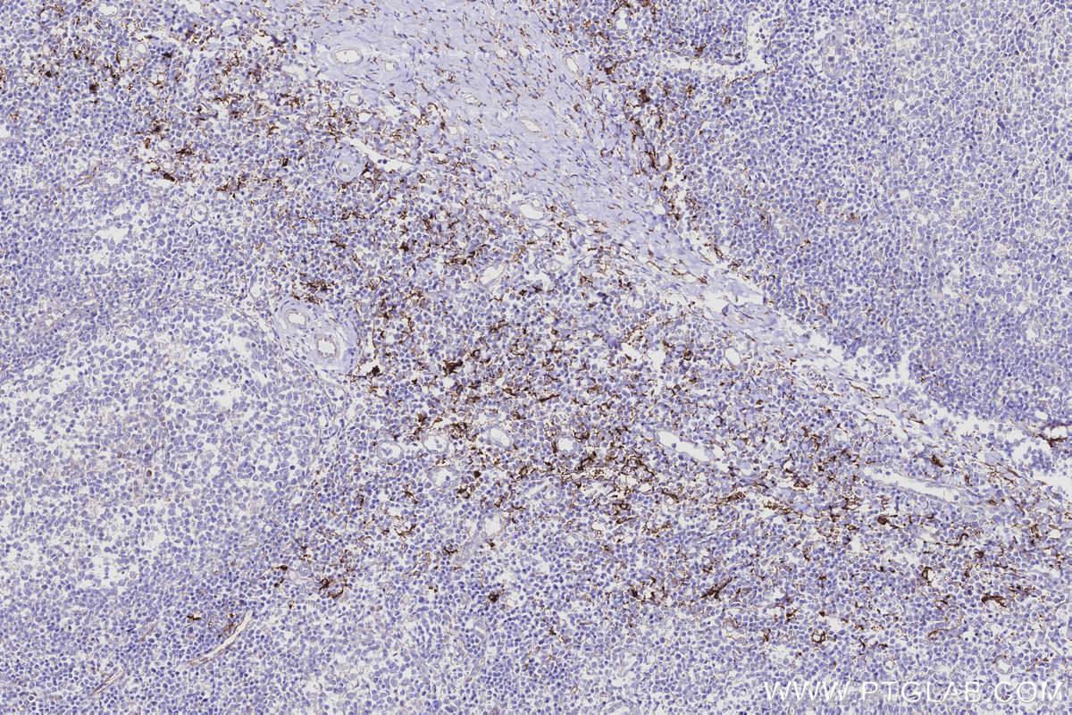IHC staining of human tonsillitis using 31621-1-AP IHC staining of human tonsillitis using 31621-1-AP