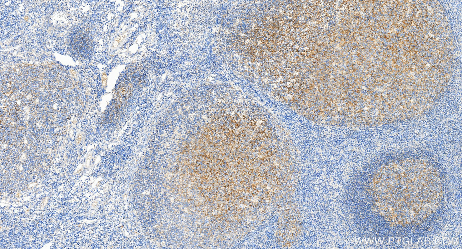 Immunohistochemical analysis of paraffin-embedded human tonsillitis tissue slide using <a class='green' href='/productredirect?CatalogNo=87097-1-RR' target='_blank'>87097-1-RR</a> (CD21 antibody) at dilution of 1:200 (under 20x lens). Heat mediated antigen retrieval with Tris-EDTA buffer (pH 9.0). This data was developed using the same antibody clone with 87097-1-PBS in a different storage buffer formulation. IHC staining of human tonsillitis using 87097-1-RR (same clone as 87097-1-PBS)