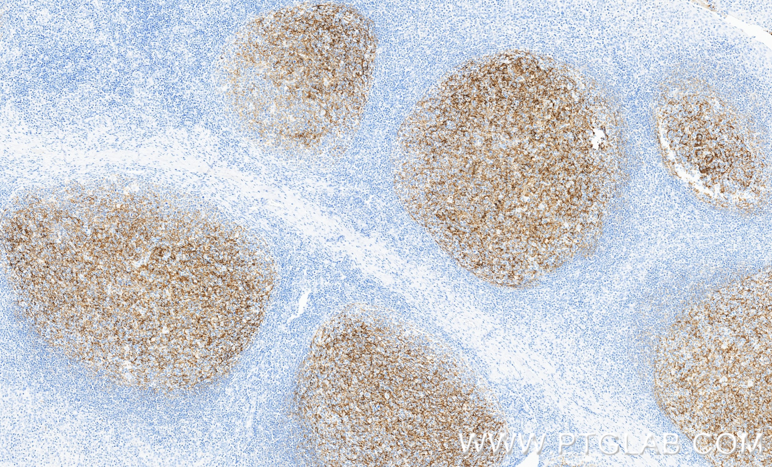 IHC staining of human tonsillitis using 87097-5-RR (same clone as 87097-5-PBS)