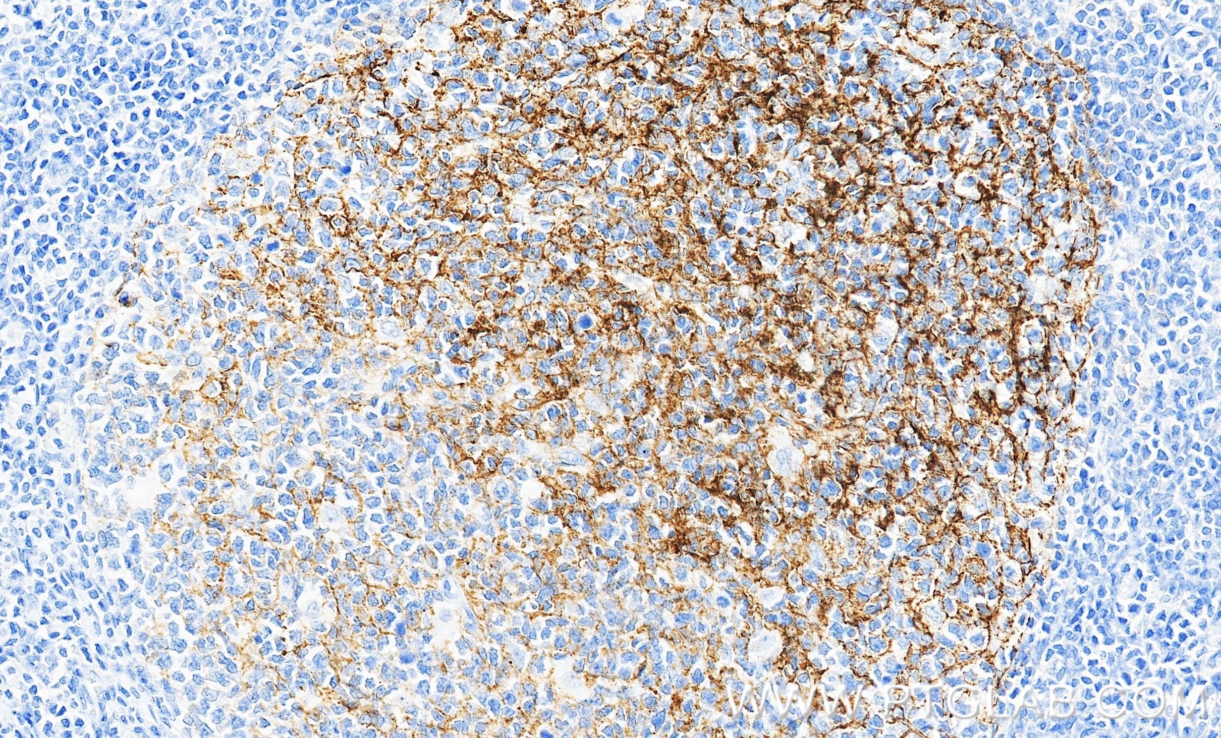 IHC staining of human tonsillitis using 87097-5-RR (same clone as 87097-5-PBS)