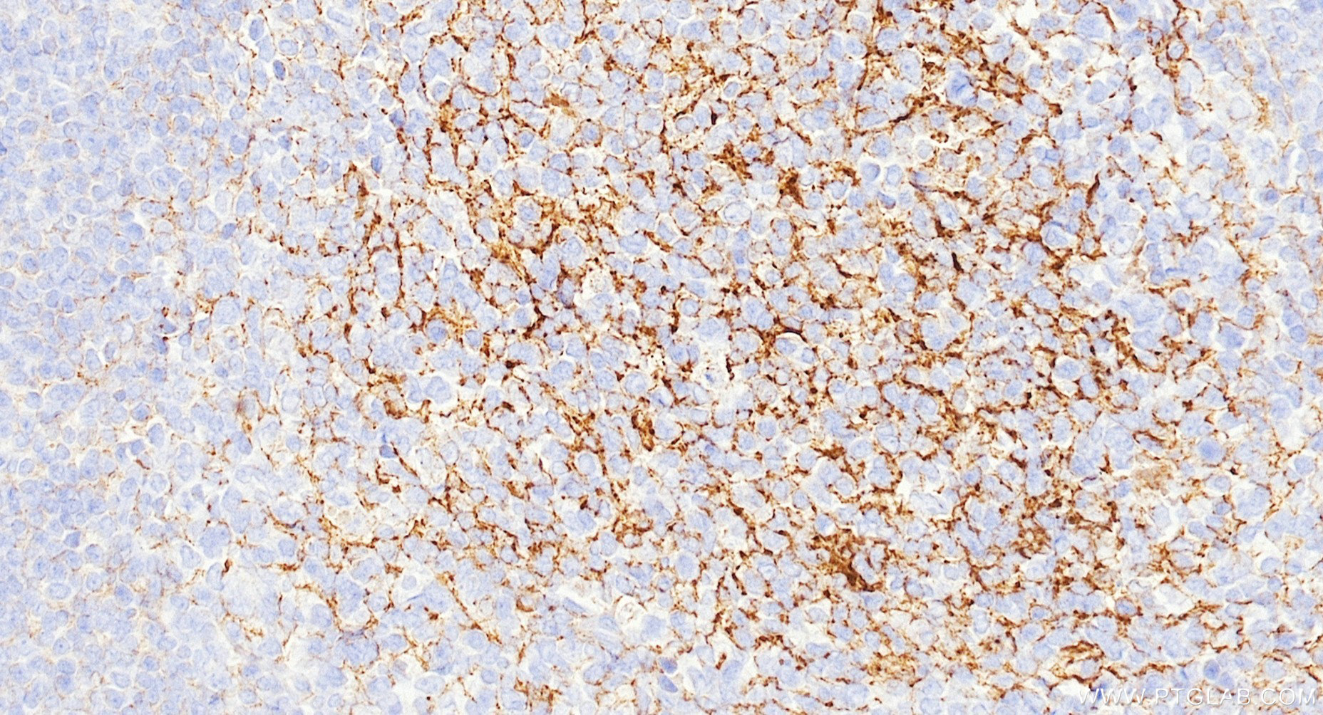 IHC staining of human tonsillitis using Biotin-87097-5 IHC staining of human tonsillitis using Biotin-87097-5