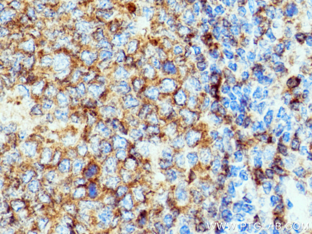 IHC staining of human tonsillitis using 21894-1-AP