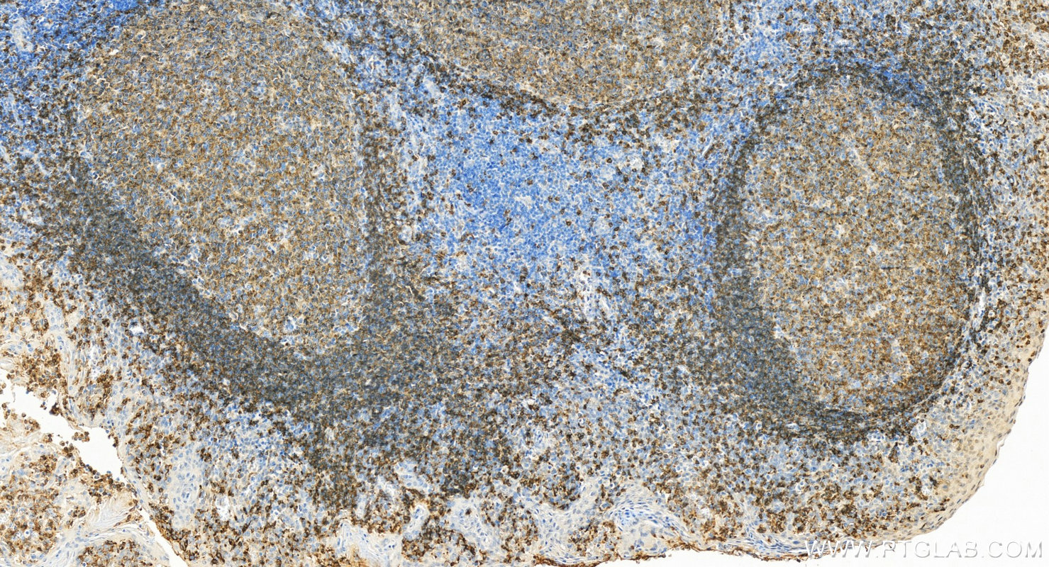 IHC staining of human tonsillitis using 30954-1-AP