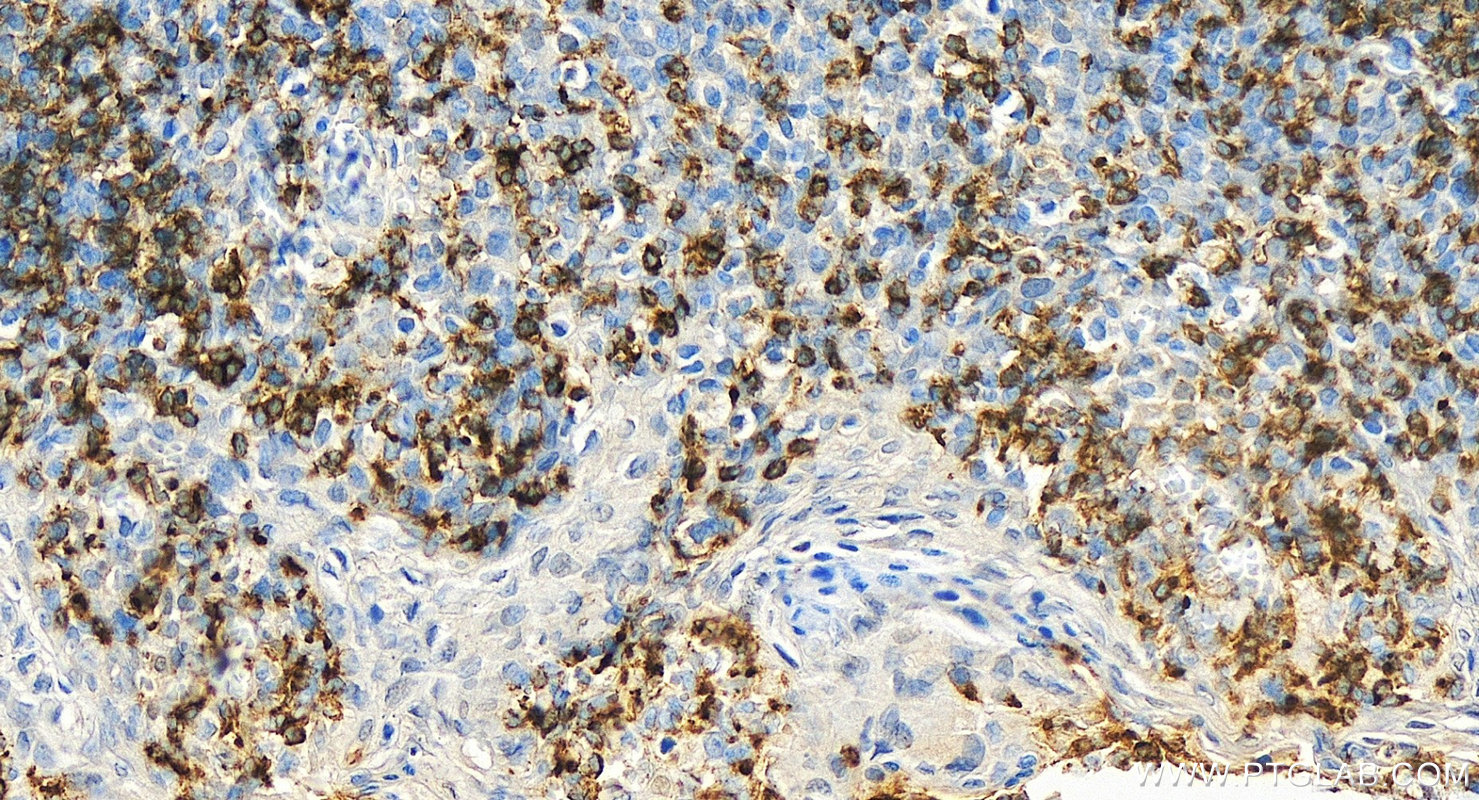 IHC staining of human tonsillitis using 30954-1-AP