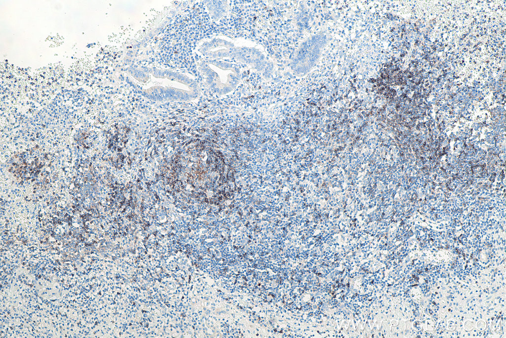 IHC staining of human appendicitis using 66103-1-Ig IHC staining of human appendicitis using 66103-1-Ig