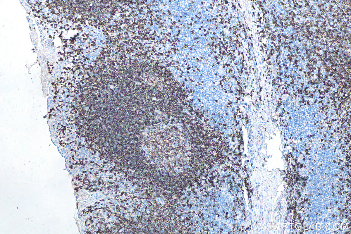 IHC staining of human tonsillitis using 66103-1-Ig (same clone as 66103-1-PBS)