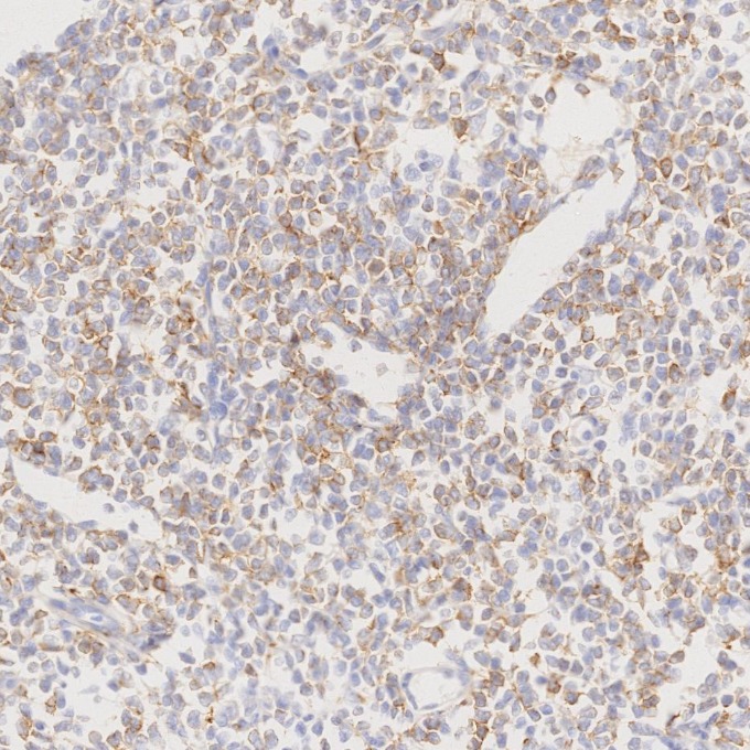 IHC staining of human lymphoma using 66103-1-Ig IHC staining of human lymphoma using 66103-1-Ig