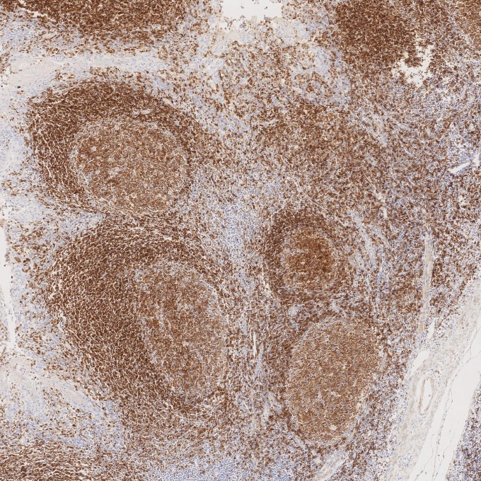 IHC staining of human tonsillitis using 66103-1-Ig IHC staining of human tonsillitis using 66103-1-Ig