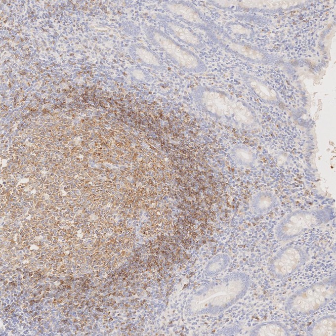 IHC staining of human appendicitis using 66103-1-Ig IHC staining of human appendicitis using 66103-1-Ig