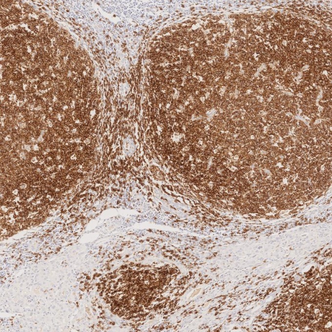 IHC staining of human lymphoma using 66103-1-Ig IHC staining of human lymphoma using 66103-1-Ig