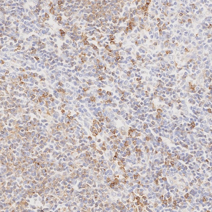 IHC staining of human lymphoma using 66103-1-Ig IHC staining of human lymphoma using 66103-1-Ig