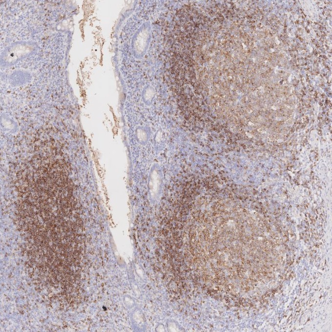 IHC staining of human appendicitis using 66103-1-Ig IHC staining of human appendicitis using 66103-1-Ig